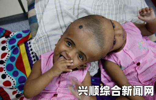 印度连体兄弟各自拥有独立上半身，独特生活体验与基本自理能力（图文）