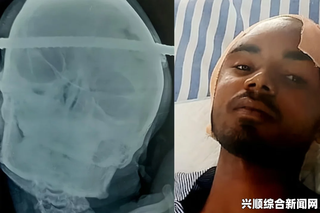罗马尼亚男子工伤失去小半个脑袋奇迹生还